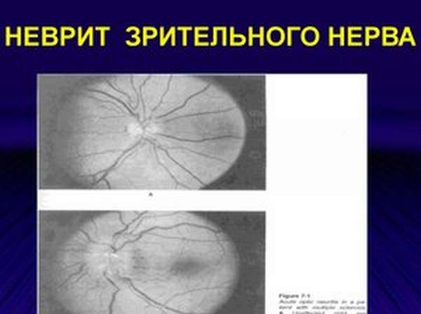 Как лечить неврит